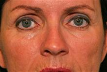 Eyelid Surgery Before Photo by Robert Buchanan, MD; Highlands, NC - Case 27172