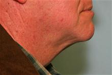 Liposuction After Photo by Robert Buchanan, MD; Highlands, NC - Case 27174