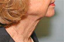 Liposuction After Photo by Robert Buchanan, MD; Highlands, NC - Case 27177