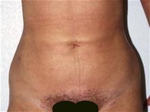 Liposuction After Photo by Robert Buchanan, MD; Highlands, NC - Case 27178