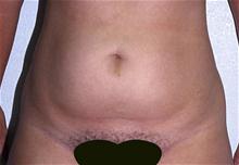 Liposuction Before Photo by Robert Buchanan, MD; Highlands, NC - Case 27178