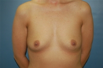 Breast Augmentation Before Photo by Huai Pan, MD; West Chester, OH - Case 10299