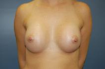 Breast Augmentation After Photo by Huai Pan, MD; West Chester, OH - Case 8101