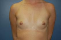 Breast Augmentation Before Photo by Huai Pan, MD; West Chester, OH - Case 8101