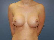 Breast Augmentation After Photo by Huai Pan, MD; West Chester, OH - Case 8103