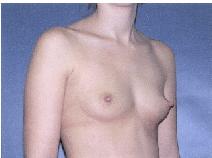 Breast Augmentation Before Photo by Huai Pan, MD; West Chester, OH - Case 8103