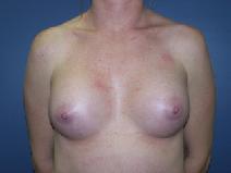 Breast Augmentation After Photo by Huai Pan, MD; West Chester, OH - Case 8108