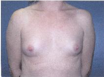 Breast Augmentation Before Photo by Huai Pan, MD; West Chester, OH - Case 8108