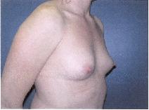 Breast Augmentation Before Photo by Huai Pan, MD; West Chester, OH - Case 8108