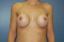Breast Augmentation After Photo by Huai Pan, MD; West Chester, OH - Case 8110