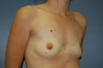 Breast Augmentation Before Photo by Huai Pan, MD; West Chester, OH - Case 8110