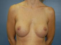Breast Augmentation After Photo by Huai Pan, MD; West Chester, OH - Case 8111