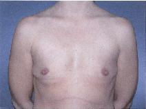 Breast Augmentation Before Photo by Huai Pan, MD; West Chester, OH - Case 8111