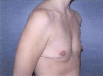 Breast Augmentation Before Photo by Huai Pan, MD; West Chester, OH - Case 8111