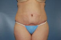 Tummy Tuck After Photo by Huai Pan, MD; West Chester, OH - Case 8173