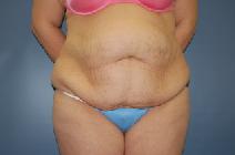 Tummy Tuck Before Photo by Huai Pan, MD; West Chester, OH - Case 8173