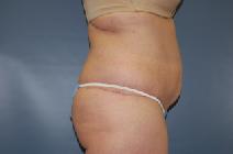 Tummy Tuck After Photo by Huai Pan, MD; West Chester, OH - Case 8173