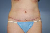 Tummy Tuck After Photo by Huai Pan, MD; West Chester, OH - Case 8197