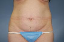 Tummy Tuck Before Photo by Huai Pan, MD; West Chester, OH - Case 8197