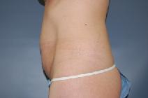 Tummy Tuck Before Photo by Huai Pan, MD; West Chester, OH - Case 8197