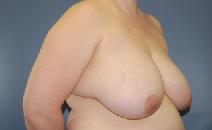 Breast Reduction Before Photo by Huai Pan, MD; West Chester, OH - Case 8199