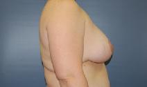 Breast Reduction After Photo by Huai Pan, MD; West Chester, OH - Case 8199