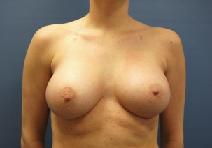 Breast Augmentation After Photo by Huai Pan, MD; West Chester, OH - Case 8200