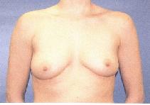 Breast Augmentation Before Photo by Huai Pan, MD; West Chester, OH - Case 8200