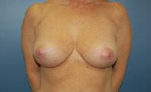 Breast Lift After Photo by Huai Pan, MD; West Chester, OH - Case 8202