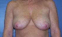 Breast Lift Before Photo by Huai Pan, MD; West Chester, OH - Case 8202