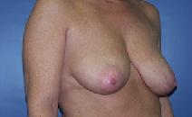 Breast Lift Before Photo by Huai Pan, MD; West Chester, OH - Case 8202