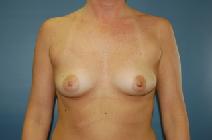 Breast Augmentation Before Photo by Huai Pan, MD; West Chester, OH - Case 8662