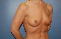 Breast Augmentation Before Photo by Huai Pan, MD; West Chester, OH - Case 8728