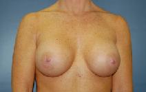 Breast Augmentation After Photo by Huai Pan, MD; West Chester, OH - Case 9134