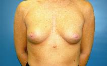 Breast Augmentation Before Photo by Huai Pan, MD; West Chester, OH - Case 9134