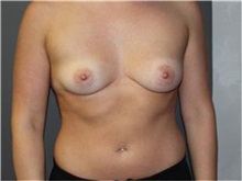 Breast Augmentation Before Photo by Sean Doherty, MD; Brookline, MA - Case 33372
