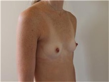 Breast Augmentation Before Photo by Sean Doherty, MD; Brookline, MA - Case 33375