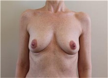 Breast Augmentation Before Photo by Sean Doherty, MD; Brookline, MA - Case 33376