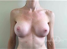 Breast Augmentation After Photo by Sean Doherty, MD; Brookline, MA - Case 33379