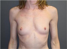 Breast Augmentation Before Photo by Sean Doherty, MD; Brookline, MA - Case 33379