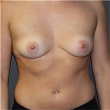 Breast Augmentation Before Photo by Sean Doherty, MD; Brookline, MA - Case 33400