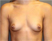 Breast Augmentation Before Photo by Sean Doherty, MD; Brookline, MA - Case 33401