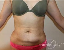 Liposuction After Photo by Sean Doherty, MD; Brookline, MA - Case 33409