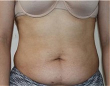 Liposuction Before Photo by Sean Doherty, MD; Brookline, MA - Case 33409