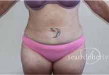 Liposuction After Photo by Sean Doherty, MD; Brookline, MA - Case 33410