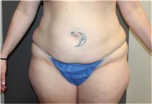Liposuction Before Photo by Sean Doherty, MD; Brookline, MA - Case 33410