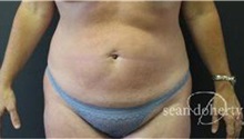 Liposuction After Photo by Sean Doherty, MD; Brookline, MA - Case 33411