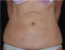 Liposuction After Photo by Sean Doherty, MD; Brookline, MA - Case 33412