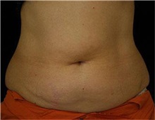 Liposuction Before Photo by Sean Doherty, MD; Brookline, MA - Case 33412