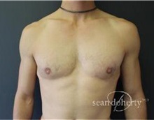 Male Breast Reduction After Photo by Sean Doherty, MD; Brookline, MA - Case 33415